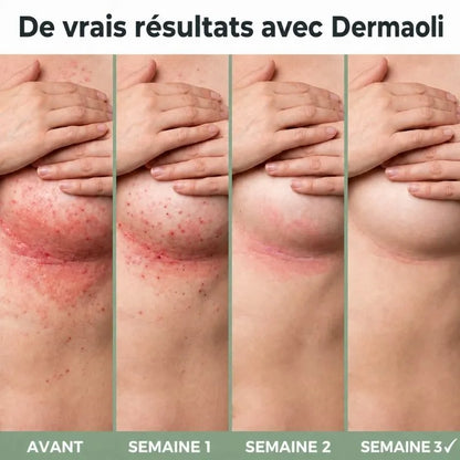 Dermaoli™ | Crème anti-irritation pour plis cutanés